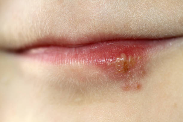 Úlcera o ampolla causada por el herpes labial simple, la cual provoca calenturas y fuegos en los labios. El herpes labial simple es una enfermedad recurrente que puede ser aliviada con multitud de productos, no obstante no hay una cura.